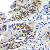 DACH / DACH1 Antibody - Immunohistochemistry of paraffin-embedded human colon carcinoma tissue.