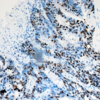 DACH / DACH1 Antibody - Immunohistochemical analysis of DACH1 staining in human colon cancer formalin fixed paraffin embedded tissue section. The section was pre-treated using heat mediated antigen retrieval with sodium citrate buffer (pH 6.0). The section was then incubated with the antibody at room temperature and detected using an HRP conjugated compact polymer system. DAB was used as the chromogen. The section was then counterstained with hematoxylin and mounted with DPX.