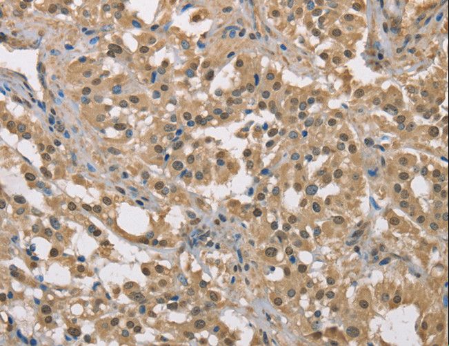DACH2 Antibody - Immunohistochemistry of paraffin-embedded Human liver cancer using DACH2 Polyclonal Antibody at dilution of 1:40.