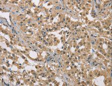 DACH2 Antibody - Immunohistochemistry of paraffin-embedded Human liver cancer using DACH2 Polyclonal Antibody at dilution of 1:40.