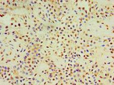 DACT3 Antibody - Immunohistochemistry of paraffin-embedded human breast cancer using antibody at 1:100 dilution.