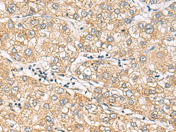 DACT3 Antibody - Immunohistochemistry of paraffin-embedded Human liver cancer tissue  using DACT3 Polyclonal Antibody at dilution of 1:70(×200)