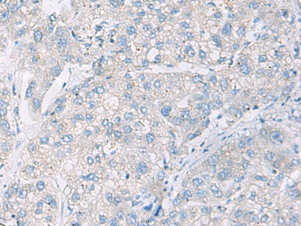 DACT3 Antibody - Immunohistochemistry of paraffin-embedded Human liver cancer tissue  using DACT3 Polyclonal Antibody at dilution of 1:55(×200)