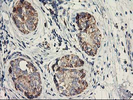 DAND5 Antibody - IHC of paraffin-embedded Adenocarcinoma of Human breast tissue using anti-DAND5 mouse monoclonal antibody.