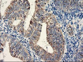 DAND5 Antibody - IHC of paraffin-embedded Adenocarcinoma of Human endometrium tissue using anti-DAND5 mouse monoclonal antibody.