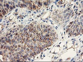 DAND5 Antibody - IHC of paraffin-embedded Carcinoma of Human bladder tissue using anti-DAND5 mouse monoclonal antibody.