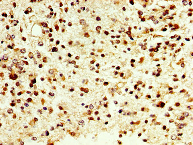 DAO / D Amino Acid Oxidase Antibody - IHC image of DAO Antibody diluted at 1:500 and staining in paraffin-embedded human glioma performed on a Leica BondTM system. After dewaxing and hydration, antigen retrieval was mediated by high pressure in a citrate buffer (pH 6.0). Section was blocked with 10% normal goat serum 30min at RT. Then primary antibody (1% BSA) was incubated at 4°C overnight. The primary is detected by a biotinylated secondary antibody and visualized using an HRP conjugated SP system.
