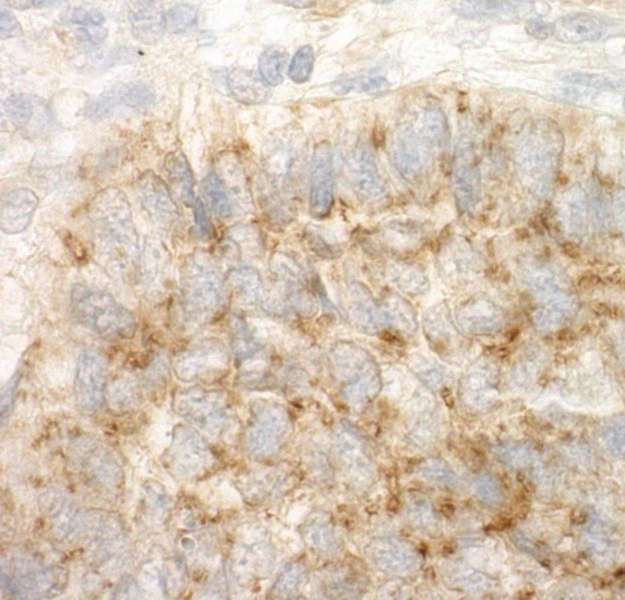 DAP-5 / EIF4G2 Antibody - Detection of Human DAP5 by Immunohistochemistry. Sample: FFPE section of human lung carcinoma. Antibody: Affinity purified rabbit anti-DAP5 used at a dilution of 1:1000 (1 ug/ml). Detection: DAB.