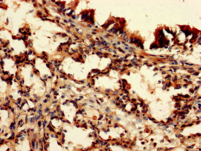 DAP Antibody - IHC image of DAP Antibody diluted at 1:150 and staining in paraffin-embedded human lung tissue performed on a Leica BondTM system. After dewaxing and hydration, antigen retrieval was mediated by high pressure in a citrate buffer (pH 6.0). Section was blocked with 10% normal goat serum 30min at RT. Then primary antibody (1% BSA) was incubated at 4°C overnight. The primary is detected by a biotinylated secondary antibody and visualized using an HRP conjugated SP system.