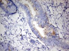 DAP3 Antibody - IHC of paraffin-embedded Adenocarcinoma of Human colon tissue using anti-DAP3 mouse monoclonal antibody. (Heat-induced epitope retrieval by 10mM citric buffer, pH6.0, 120°C for 3min).