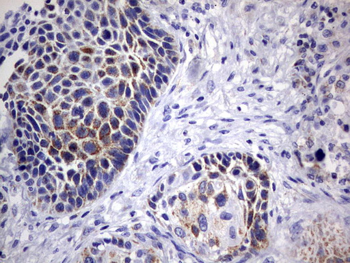 DAP3 Antibody - IHC of paraffin-embedded Carcinoma of Human lung tissue using anti-DAP3 mouse monoclonal antibody. (Heat-induced epitope retrieval by 10mM citric buffer, pH6.0, 120°C for 3min).