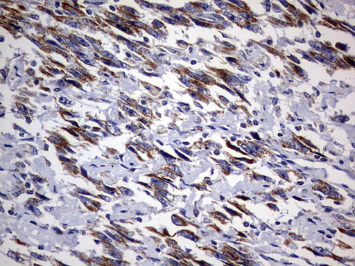 DAP3 Antibody - IHC of paraffin-embedded Adenocarcinoma of Human ovary tissue using anti-DAP3 mouse monoclonal antibody. (Heat-induced epitope retrieval by 10mM citric buffer, pH6.0, 120°C for 3min).