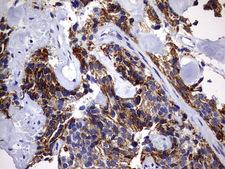 DAP3 Antibody - IHC of paraffin-embedded Adenocarcinoma of Human breast tissue using anti-DAP3 mouse monoclonal antibody. (Heat-induced epitope retrieval by 10mM citric buffer, pH6.0, 120°C for 3min).
