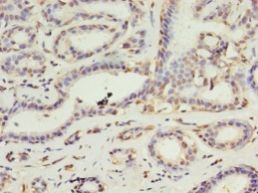 DAPK2 / DAP Kinase 2 Antibody - Immunohistochemistry of paraffin-embedded human breast cancer tissue using antibody at 1:100 dilution.  This image was taken for the unconjugated form of this product. Other forms have not been tested.