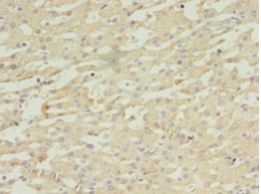 DAPK2 / DAP Kinase 2 Antibody - Immunohistochemistry of paraffin-embedded human liver cancer tissue using antibody at 1:100 dilution.  This image was taken for the unconjugated form of this product. Other forms have not been tested.