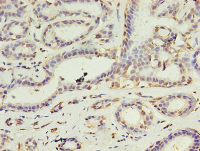 DAPK2 / DAP Kinase 2 Antibody - Immunohistochemistry of paraffin-embedded human breast cancer using DAPK2 Antibody at dilution of 1:100