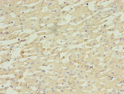 DAPK2 / DAP Kinase 2 Antibody - Immunohistochemistry of paraffin-embedded human liver cancer using DAPK2 Antibody at dilution of 1:100
