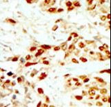 DAPK2 / DAP Kinase 2 Antibody - Formalin-fixed and paraffin-embedded human cancer tissue reacted with the primary antibody, which was peroxidase-conjugated to the secondary antibody, followed by DAB staining. This data demonstrates the use of this antibody for immunohistochemistry; clinical relevance has not been evaluated. BC = breast carcinoma; HC = hepatocarcinoma.