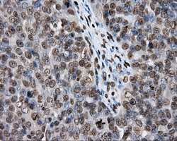 DAPK2 / DAP Kinase 2 Antibody - Immunohistochemical staining of paraffin-embedded Adenocarcinoma of ovary tissue using anti-DAPK2 mouse monoclonal antibody. (Dilution 1:50).