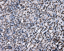 DAPK2 / DAP Kinase 2 Antibody - Immunohistochemical staining of paraffin-embedded Carcinoma of thyroid tissue using anti-DAPK2 mouse monoclonal antibody. (Dilution 1:50).