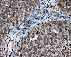 DAPK2 / DAP Kinase 2 Antibody - Immunohistochemical staining of paraffin-embedded Adenocarcinoma of ovary tissue using anti-DAPK2 mouse monoclonal antibody. (Dilution 1:50).