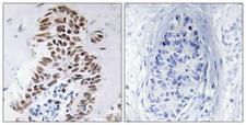 DAPK3 / ZIP Kinase Antibody - Immunohistochemistry analysis of paraffin-embedded human lung carcinoma tissue, using DAPK3 Antibody. The picture on the right is blocked with the synthesized peptide.