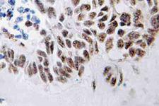 DAPK3 / ZIP Kinase Antibody - IHC of ZIP-kinase (K261) pAb in paraffin-embedded human lung carcinoma tissue.