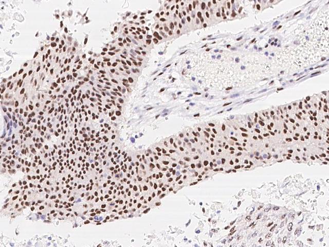 DAPK3 / ZIP Kinase Antibody - Immunochemical staining of human DAPK3 in human lung cancer with rabbit polyclonal antibody at 1:1000 dilution, formalin-fixed paraffin embedded sections.