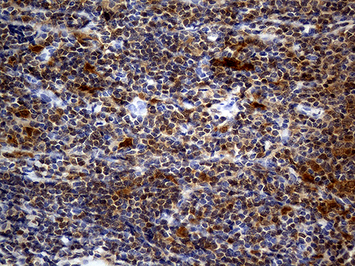 DAPP1 / BAM32 Antibody - Immunohistochemical staining of paraffin-embedded Human lymphoma tissue using anti-DAPP1 mouse monoclonal antibody. (Heat-induced epitope retrieval by 1mM EDTA in 10mM Tris buffer. (pH8.5) at 120°C for 3 min. (1:500)