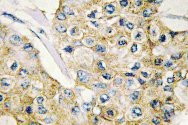 DAPP1 / BAM32 Antibody - IHC of DAPP1 (E135) pAb in paraffin-embedded human breast carcinoma tissue.