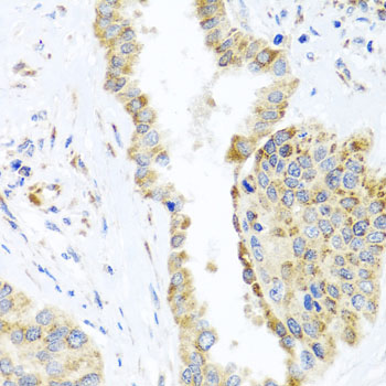 DARS2 Antibody - Immunohistochemistry of paraffin-embedded human lung cancer tissue.