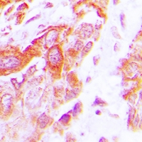 DARS2 Antibody - Immunohistochemical analysis of AspRS staining in human lung cancer formalin fixed paraffin embedded tissue section. The section was pre-treated using heat mediated antigen retrieval with sodium citrate buffer (pH 6.0). The section was then incubated with the antibody at room temperature and detected using an HRP conjugated compact polymer system. DAB was used as the chromogen. The section was then counterstained with hematoxylin and mounted with DPX.