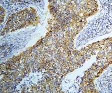 DARS2 Antibody - IHC staining of FFPE human lung cancer with DARS2 antibody at 1ug/ml. HIER: boil tissue sections in pH6, 10mM citrate buffer, for 10-20 min and allow to cool before testing.