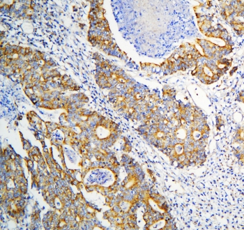 DARS2 Antibody - IHC staining of FFPE human intestinal cancer with DARS2 antibody at 1ug/ml. HIER: boil tissue sections in pH6, 10mM citrate buffer, for 10-20 min and allow to cool before testing.