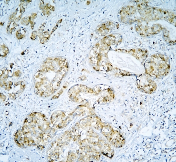 DARS2 Antibody - IHC staining of FFPE human breast cancer with DARS2 antibody at 1ug/ml. HIER: boil tissue sections in pH6, 10mM citrate buffer, for 10-20 min and allow to cool before testing.