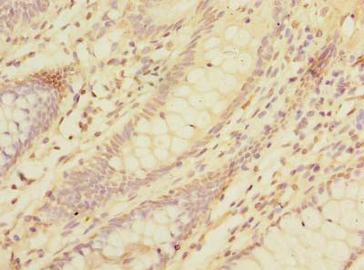 DAT1 / LMO3 Antibody - Immunohistochemistry of paraffin-embedded human colon cancer using antibody at dilution of 1:100.