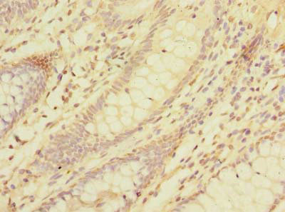 DAT1 / LMO3 Antibody - Immunohistochemistry of paraffin-embedded human colon cancer using LMO3 Antibody at dilution of 1:100