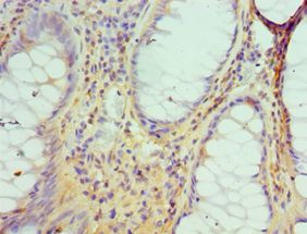 DATF1 / DIDO1 Antibody - Immunohistochemistry of paraffin-embedded human colon cancer using antibody at 1:100 dilution.