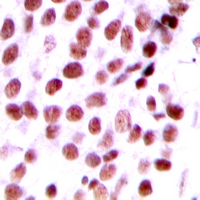 DATF1 / DIDO1 Antibody - Immunohistochemical analysis of DIDO1 staining in human breast cancer formalin fixed paraffin embedded tissue section. The section was pre-treated using heat mediated antigen retrieval with sodium citrate buffer (pH 6.0). The section was then incubated with the antibody at room temperature and detected with HRP and DAB as chromogen. The section was then counterstained with hematoxylin and mounted with DPX.