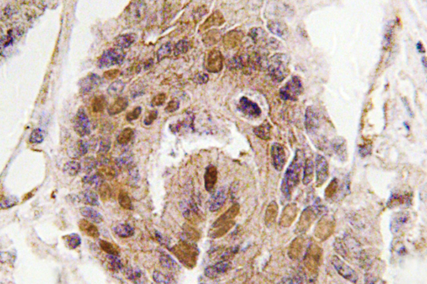 DATF1 / DIDO1 Antibody - IHC of DATF1 / DIDO1 (S186) pAb in paraffin-embedded human colon carcinoma tissue.