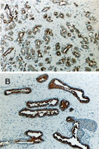 DAXX Antibody - Formalin-fixed paraffin-embedded tissue sections of human prostate cancer (A and B) stained for Daxx expression using Polyclonal Antibody to DAXX at 1:2000. Hematoxylin-Eosin counterstain.