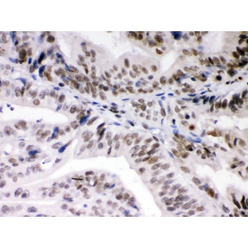DAXX Antibody - DAXX antibody IHC-paraffin. IHC(P): Human Intestinal Cancer Tissue.