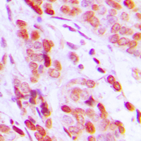 DAXX Antibody - Immunohistochemical analysis of DAXX staining in human breast cancer formalin fixed paraffin embedded tissue section. The section was pre-treated using heat mediated antigen retrieval with sodium citrate buffer (pH 6.0). The section was then incubated with the antibody at room temperature and detected using an HRP-conjugated compact polymer system. DAB was used as the chromogen. The section was then counterstained with hematoxylin and mounted with DPX.