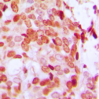 DAXX Antibody - Immunohistochemical analysis of DAXX (pS668) staining in human breast cancer formalin fixed paraffin embedded tissue section. The section was pre-treated using heat mediated antigen retrieval with sodium citrate buffer (pH 6.0). The section was then incubated with the antibody at room temperature and detected using an HRP-conjugated compact polymer system. DAB was used as the chromogen. The section was then counterstained with hematoxylin and mounted with DPX.