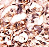 DAXX Antibody - Formalin-fixed and paraffin-embedded human cancer tissue reacted with the primary antibody, which was peroxidase-conjugated to the secondary antibody, followed by AEC staining. This data demonstrates the use of this antibody for immunohistochemistry; clinical relevance has not been evaluated. BC = breast carcinoma; HC = hepatocarcinoma.