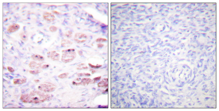 DAXX Antibody - Immunohistochemistry analysis of paraffin-embedded human ovary, using Daxx (Phospho-Ser668) Antibody. The picture on the right is blocked with the phospho peptide.