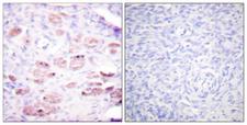 DAXX Antibody - P-peptide - + Immunohistochemical analysis of paraffin-embedded human ovary tissue using Daxx (Phospho-Ser668) Antibody.