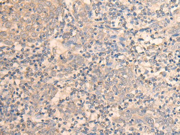 DAZ1 / DAZ Antibody - Immunohistochemistry of paraffin-embedded Human cervical cancer tissue  using DAZ1 Polyclonal Antibody at dilution of 1:55(×200)