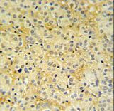 DAZAP2 Antibody - DAZAP2 Antibody IHC of formalin-fixed and paraffin-embedded prostate carcinoma followed by peroxidase-conjugated secondary antibody and DAB staining.