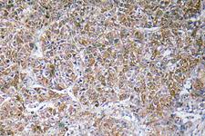 DBI / ACBD1 Antibody - Immunohistochemistry analysis of ACBP antibody in paraffin-embedded human liver carcinoma tissue.